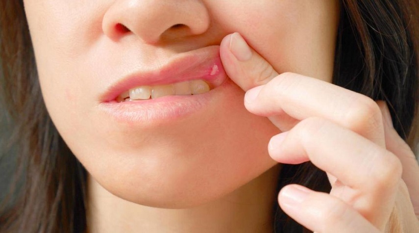 مشاكل في الفم تسهم في اكتشاف السرطان المبكر