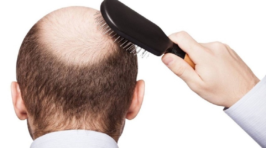 عوامل رئيسية تسبب تساقط الشعر