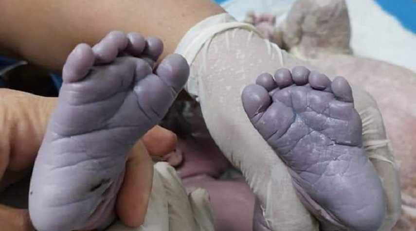 في حالة نادرة.. ولادة طفلة عراقية بـ24 إصبعاً 